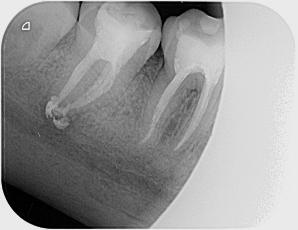 Caso clínico 1 de endodoncia - RX control 6 meses