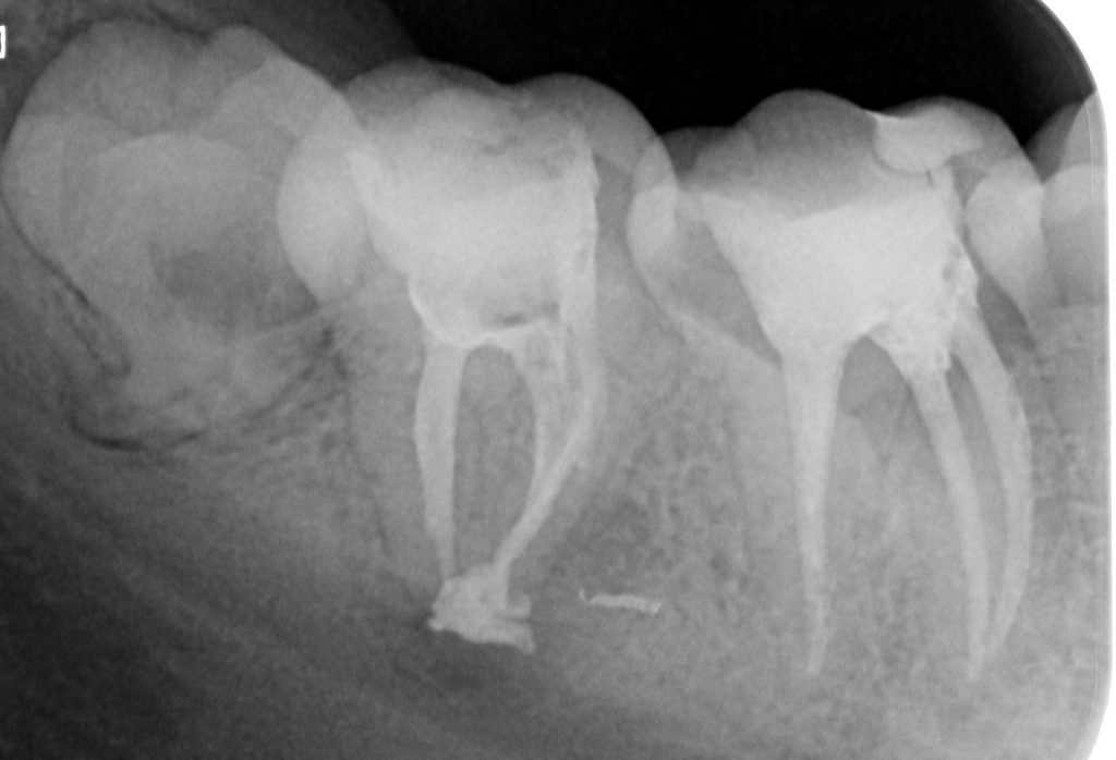 Caso clínico 1 de endodoncia - RX final