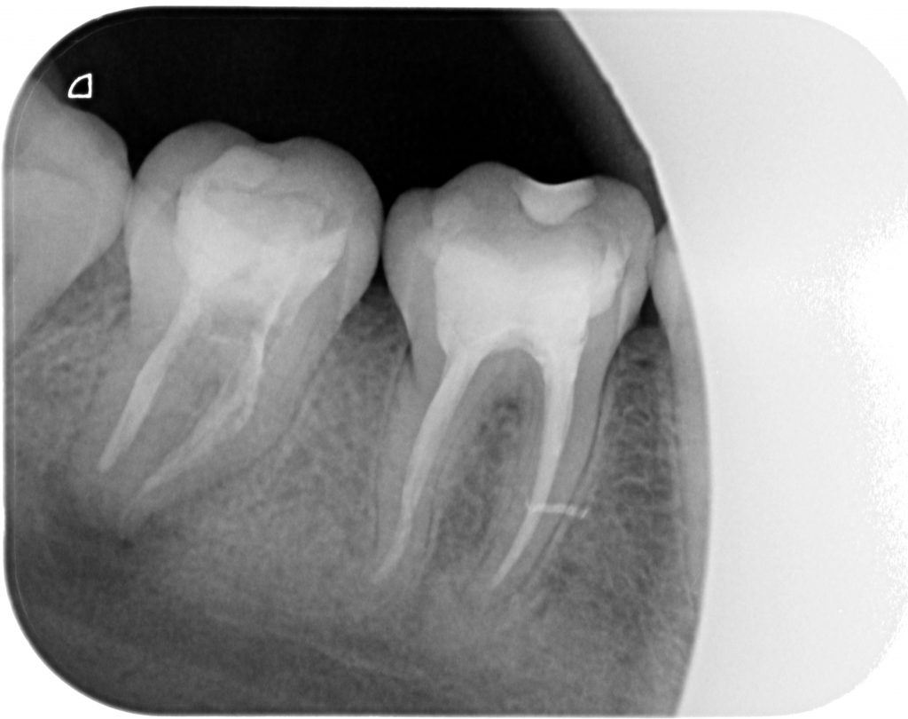 Caso clínico 1 de endodoncia - RX inicial